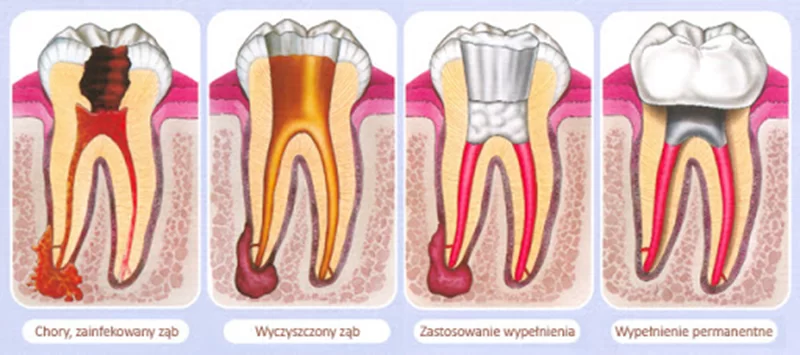 próchnica 2image003-3