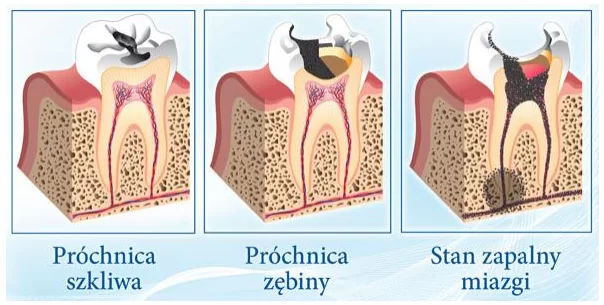 próchnicastomatologia1_1490188772