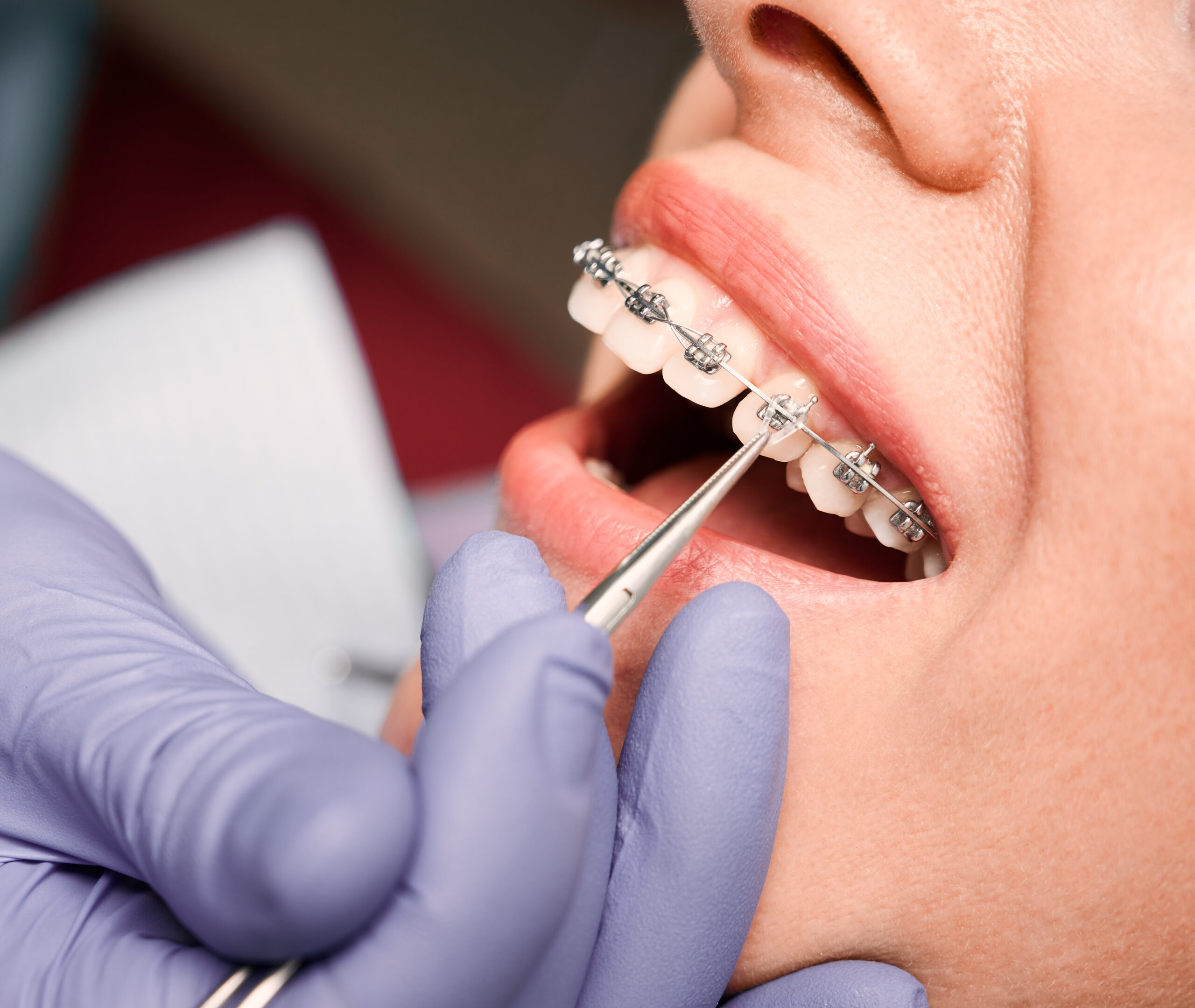 Orthodontist placing rubber bands on female patient braces. Orthodontist placing rubber bands on female patient braces.